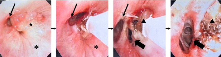 Endobronchial Lipoma Treated With Endoscopic Microwave Coagulation to Relieve Atelectasis: The First Case Report.