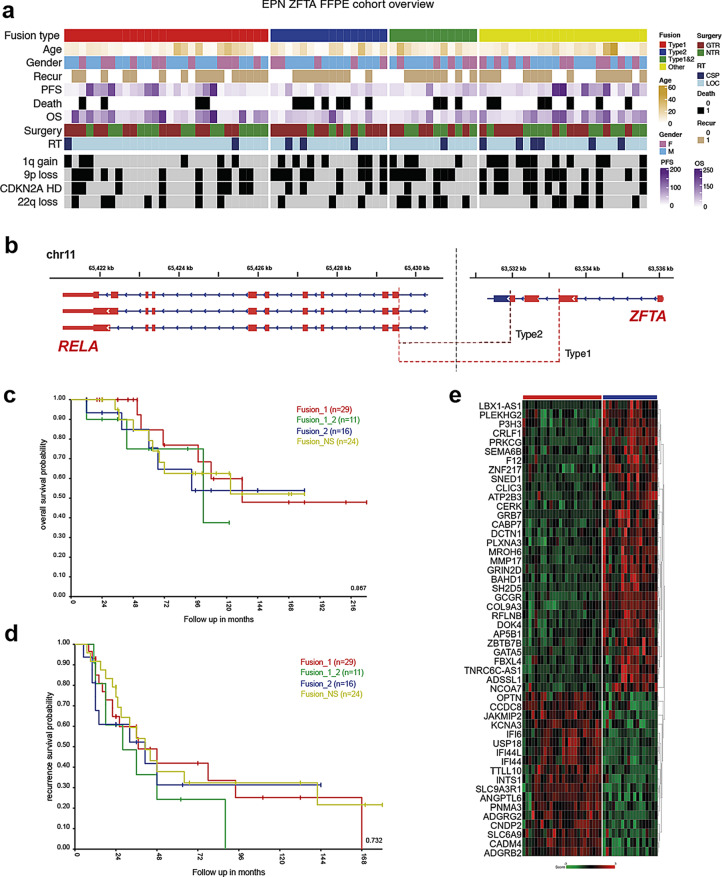 Correction: Biglycan-driven risk stratification in ZFTA-RELA fusion supratentorial ependymomas through transcriptome profiling.