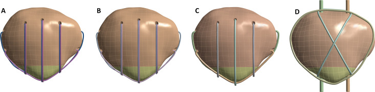Candy box technique with sutures and Nice knot : a novel approach to inferior pole patellar fractures.
