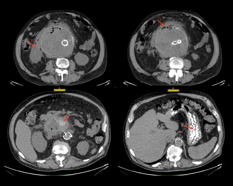 Aorto-Duodenal Fistula After Emergency Endovascular Repair of a 14-cm Abdominal Aortic Aneurysm in a 68-Year-Old Man.
