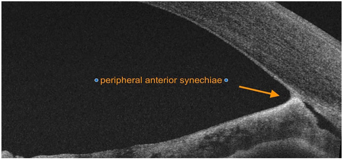 Descemet's membrane endothelial keratoplasty in an eye with iridocorneal endothelial syndrome and rare association of corneal ectasia.