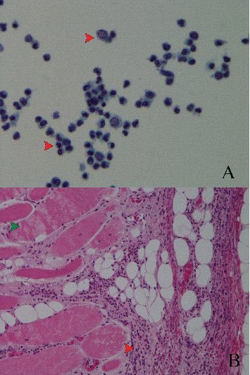 Pneumococcal Pyopericardium With Xiphoid Osteomyelitis in HIV/AIDS: A Rare but Potentially Fatal Complication.