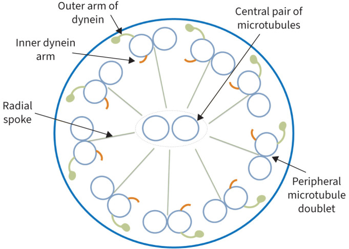 A 28-year-old woman with chronic respiratory symptoms: navigating a diagnostic puzzle.