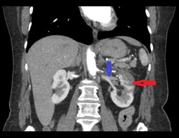Transient Renal Artery Stenosis in Renal Infarction: A Case Report.