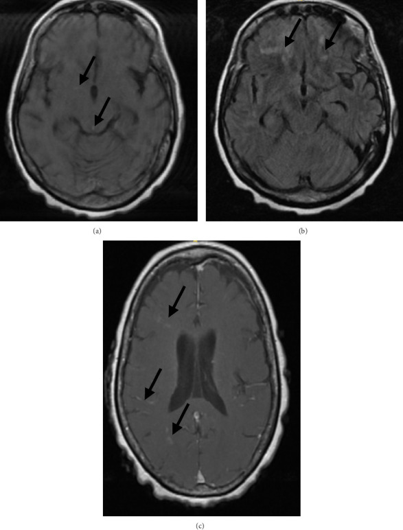 Presumed Cerebral Vasculitis Following Pneumococcal Meningitis: A Rare but Life-Threatening Complication.
