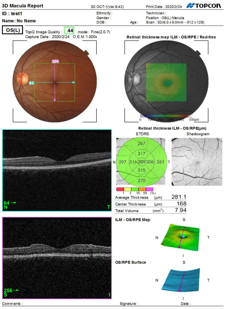 The Impact of Helicobacter pylori Infection on Retinal Nerve Fiber Layer and Macula.