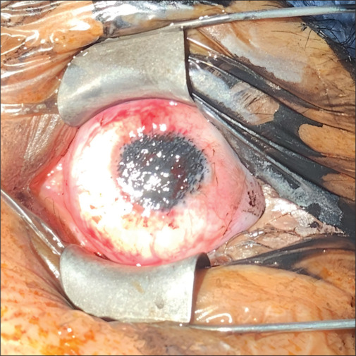 Keratopigmentation in the modern era: A review of current techniques, results, and safety.