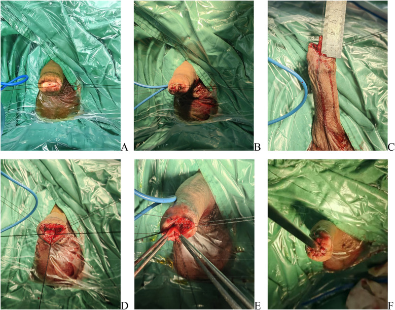 Clinical observation of transurethral reconstruction of urethral meatus and navicularis fossa short strictures with annular inlay oral mucosa graft urethroplasty.