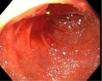 Hemostasis With Fully Covered Self-Expanding Bare Metal Stent as a Bridge to Liver Transplantation in a Patient With Acute Liver Failure and Hemodynamically Unstable Hemobilia.