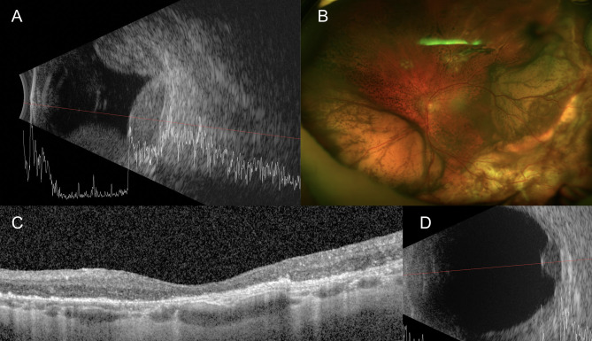 Clinical Characteristics and Treatment Outcomes of Breakthrough Vitreous Hemorrhage in Peripheral Exudative Hemorrhagic Chorioretinopathy (PEHCR).