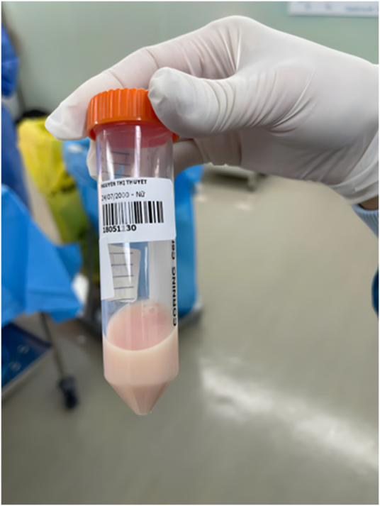 The first case report of chylous ascites in a twin pregnancy following <i>in vitro</i> fertilization: a case report of chylous ascites in twin pregnancy.