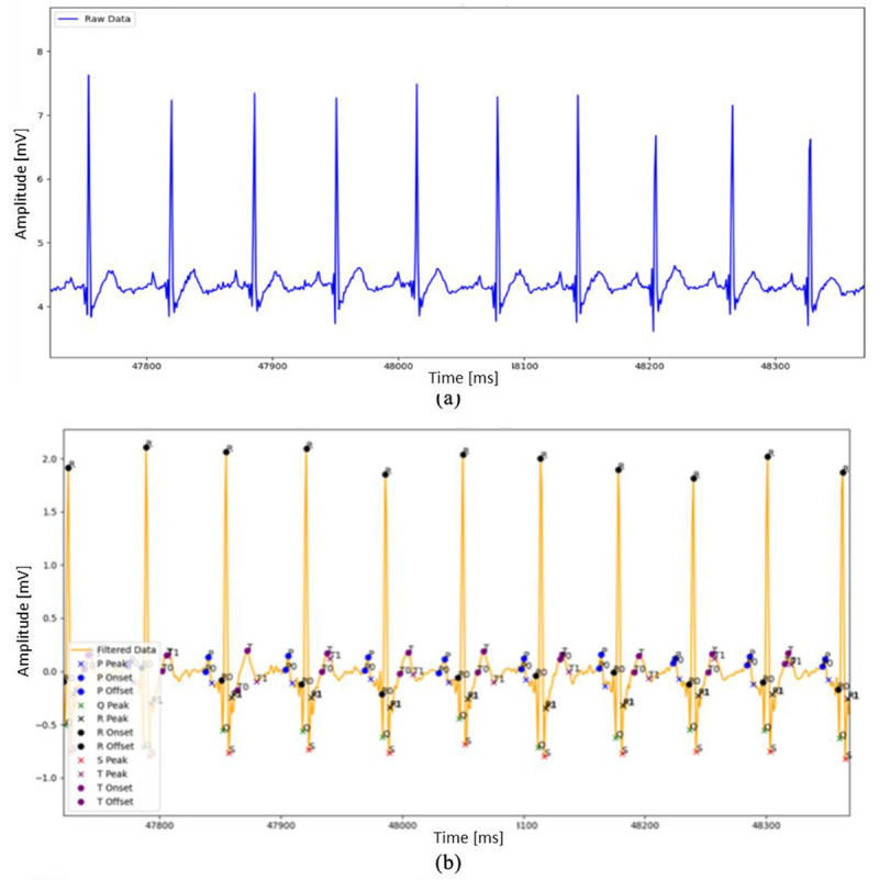 Portable Holter with Cloud-Based Learning Analytics for Real-Time Health Monitoring.
