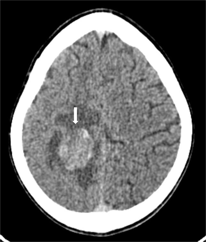 Hemorrhagic brain metastasis as the initial presentation of osteosarcoma: a rare case report.