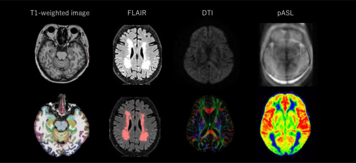 Combinations of multimodal neuroimaging biomarkers and cognitive test scores to identify patients with cognitive impairment.