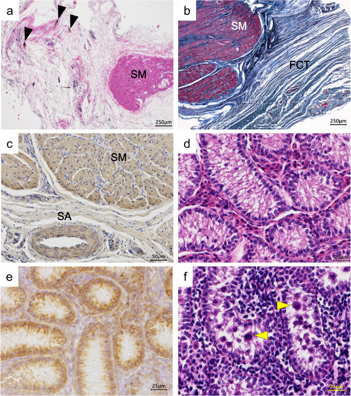 XXX/XY chimerism with urogenital malformations in a Japanese black calf.