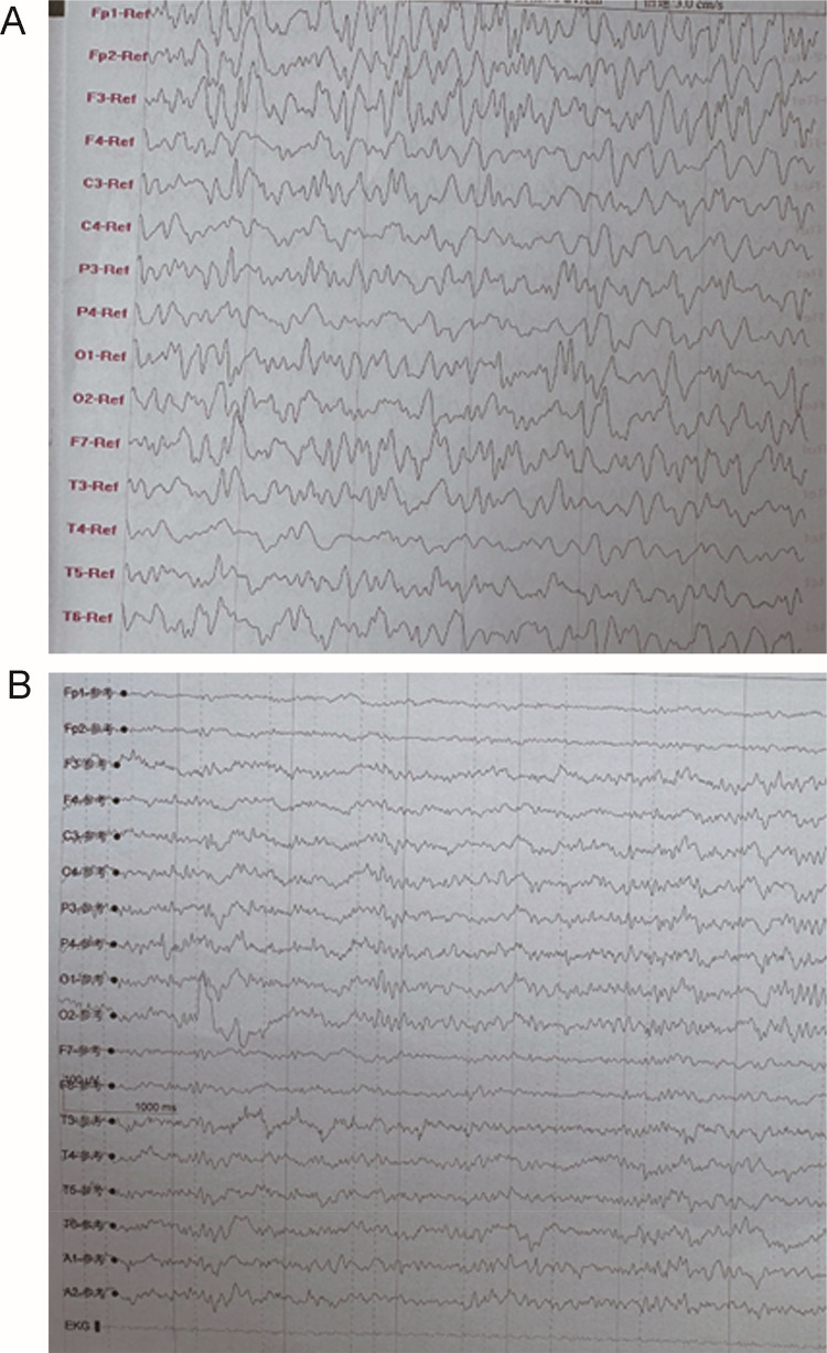 Reversible Toxic-Metabolic Encephalopathy in Fluroacetamide Intoxication: A Case Report and Review of the Literature.