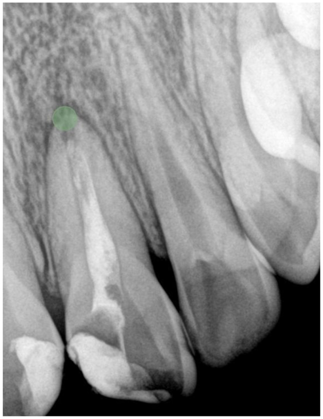Radiomics-based classification of pediatric dental trauma in periapical radiographs: a preliminary study.