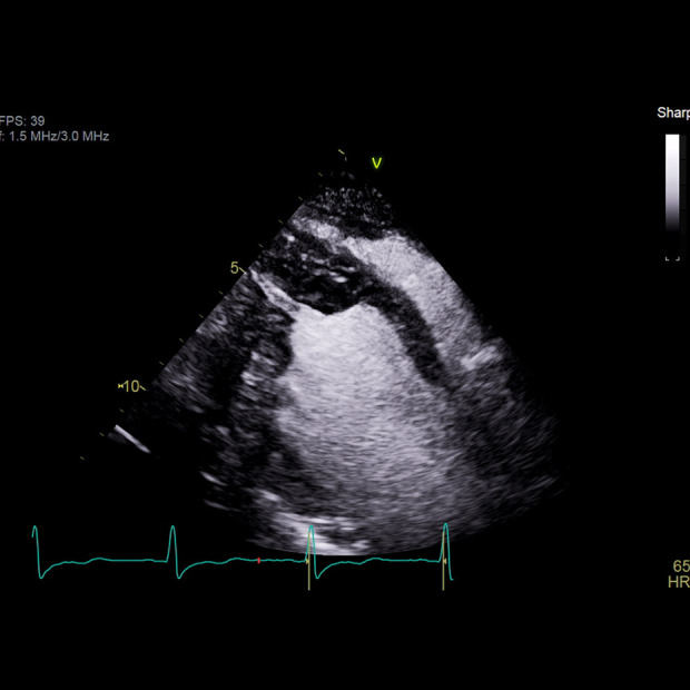 Management of Malignant Arrhythmia in Apical Hypertrophic Cardiomyopathy: A Case Report.