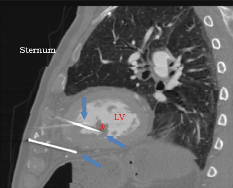 Conservative non-surgical management of penetrating cardiac injury with three retained metal nails: a case report.