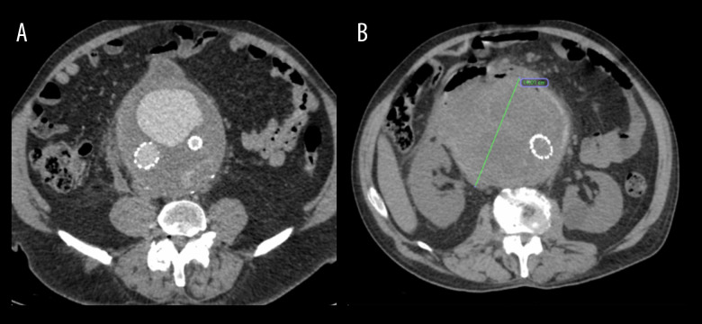 Aorto-Duodenal Fistula After Emergency Endovascular Repair of a 14-cm Abdominal Aortic Aneurysm in a 68-Year-Old Man.
