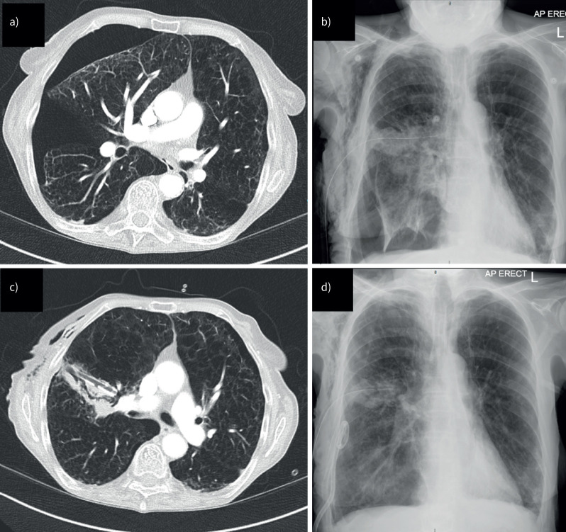 New strategies in the management of pneumothorax.