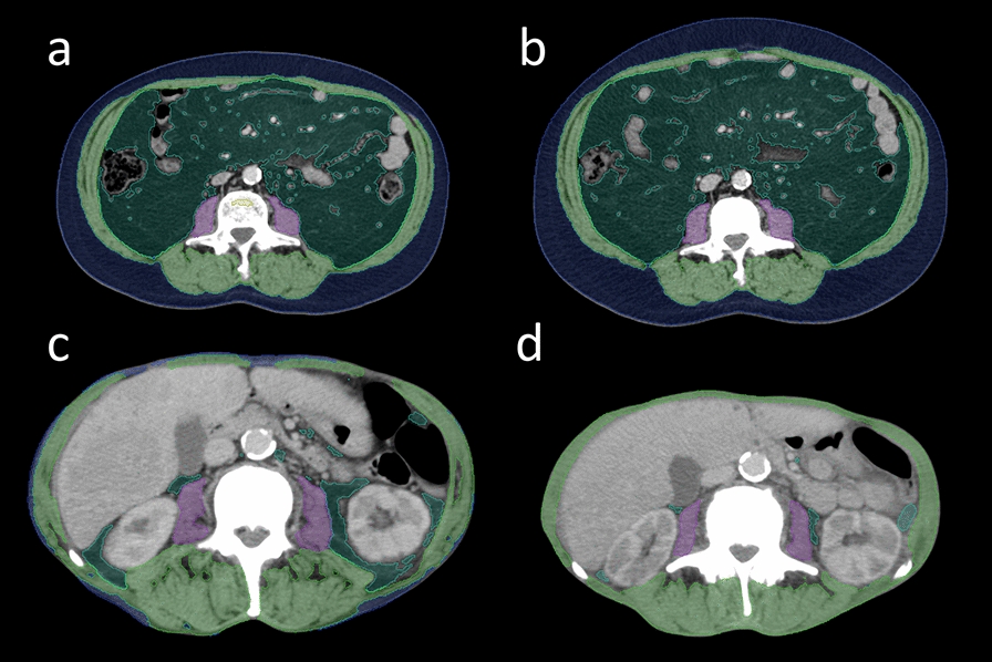 AI-driven body composition monitoring and its prognostic role in mCRPC undergoing lutetium-177 PSMA radioligand therapy: insights from a retrospective single-center analysis.