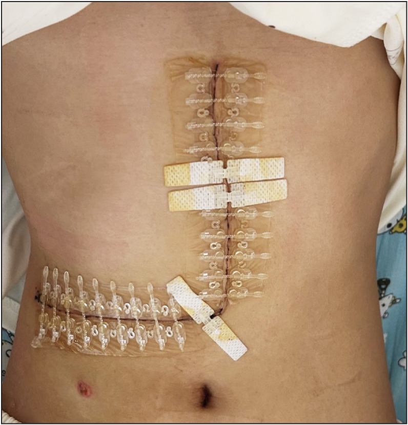Robotic liver resection for hepatic focal nodular hyperplasia in children: comparison with open surgery.