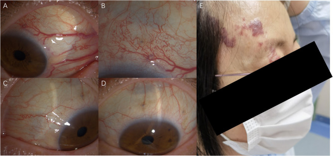 Choroidal hemangioma in Sturge-Weber syndrome elucidated by ultra-widefield swept-source optical coherence tomography angiography.
