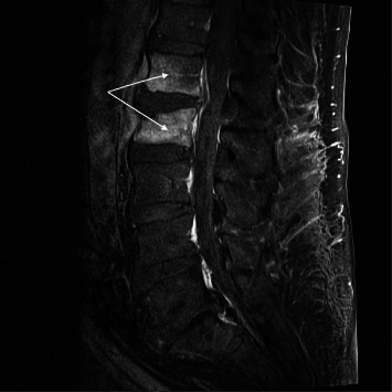 <i>Aerococcus urinae</i> Spondylodiscitis: A Case Report and Review of the Literature.