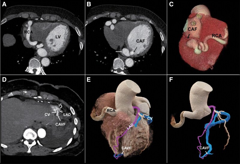 Photon-counting detector computed tomography for the diagnosis of coronary arteriovenous fistula: a new finding after repair of a coronary fistula case.