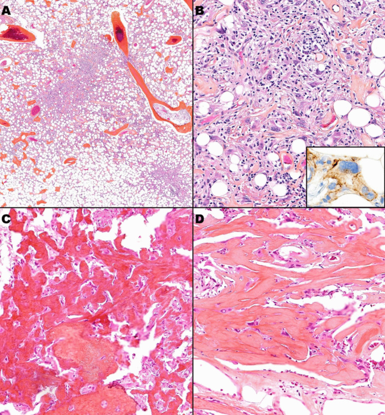 Oncogenic rickets diagnosed at age 8 and the risk of persistent rickets: a rare case of pediatric-onset tumor-induced osteomalacia.