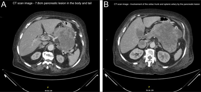 Pancreatic Metastasis From a Vulvar Melanoma Diagnosed by Endoscopic Ultrasound-Guided Fine-Needle Biopsy.