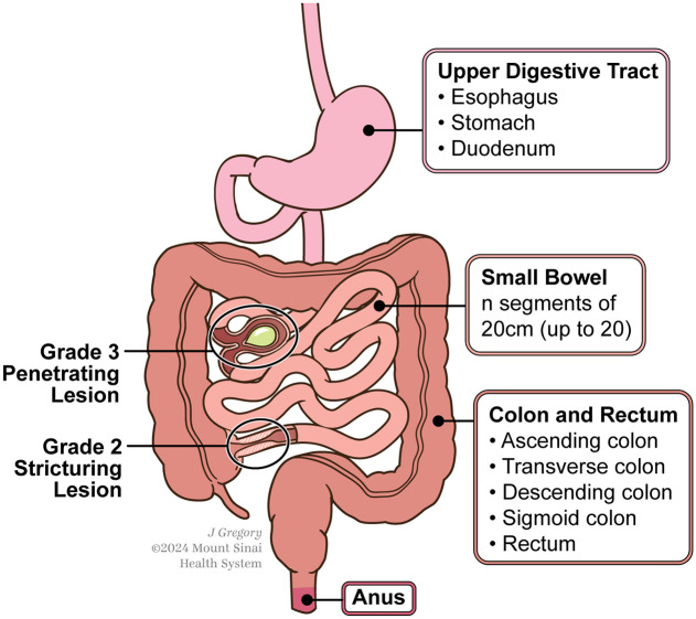 The CROCO (CROhn's Disease COhort Study) - study design and protocol.