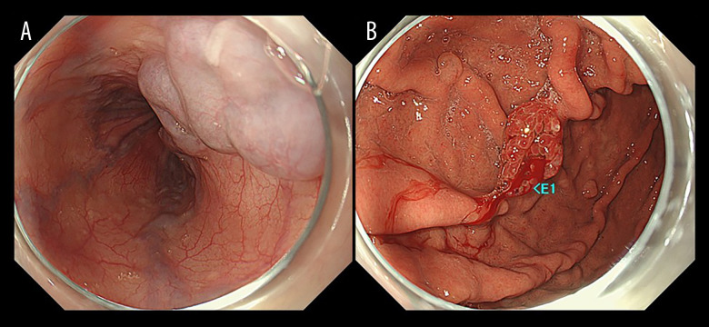 Rapid Progression of Primary Hepatic Neuroendocrine Carcinoma: A Case Report Demonstrating Drastic Oncological Behavior.