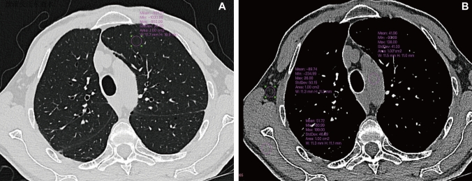 Low-dose ultrahigh-resolution PCCT enhances subsolid nodule characterization.