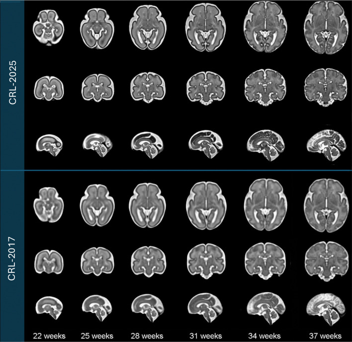 An MRI Atlas of the Human Fetal Brain: Reference and Segmentation Tools for Fetal Brain MRI Analysis.