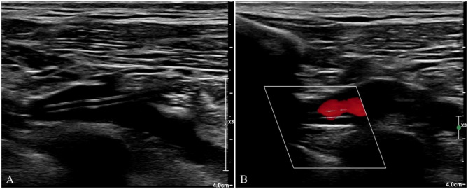 Venous Port implantation in persistent left superior vena cava with azygos vein variation: a case report and literature review.