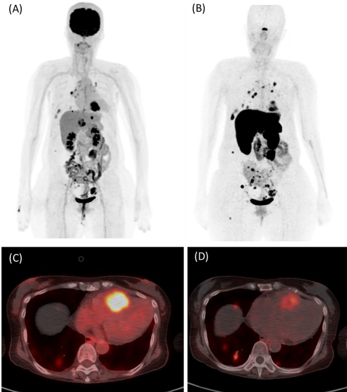 Kussmaul's Sign Provoked by Intracardiac Metastasis of Endometrial Neuroendocrine Tumor.