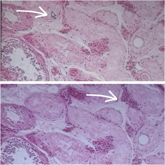 Ipsilateral polyorchidism with cryptorchidism in a pediatric patient: a rare case report from a resource-limited setting.