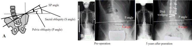 Effect of the discrepancy between sacral and pelvic obliquity on postoperative disk wedging below the lower instrumented vertebra in patients with Lenke type 5 adolescent idiopathic scoliosis: a retrospective study in Japan.