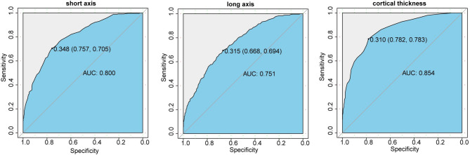 A non-invasive preoperative model for predicting sentinel lymph node metastasis in breast cancer using clinical data and MRI.