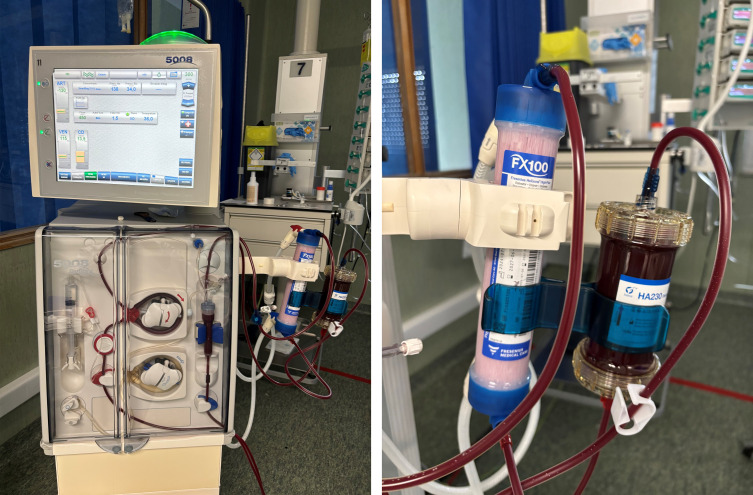 Case Report: Effective methotrexate removal by combined hemodialysis and polymeric resin hemoadsorption.
