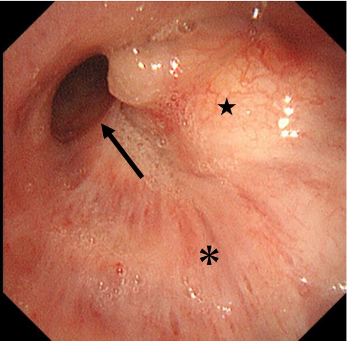 Endobronchial Lipoma Treated With Endoscopic Microwave Coagulation to Relieve Atelectasis: The First Case Report.