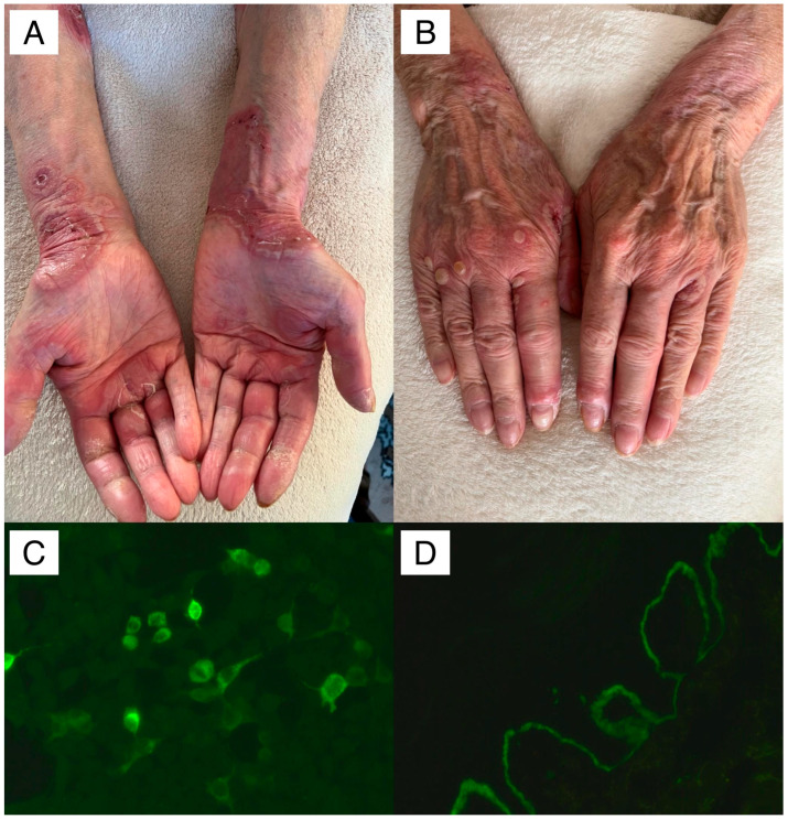 Antibodies to Laminin β4 in Pemphigoid Diseases: Clinical-Laboratory Experience of a Single Central European Reference Centre.