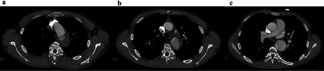 Delayed diagnosis of aortic dissection: the overlooked clues on chest X-ray.