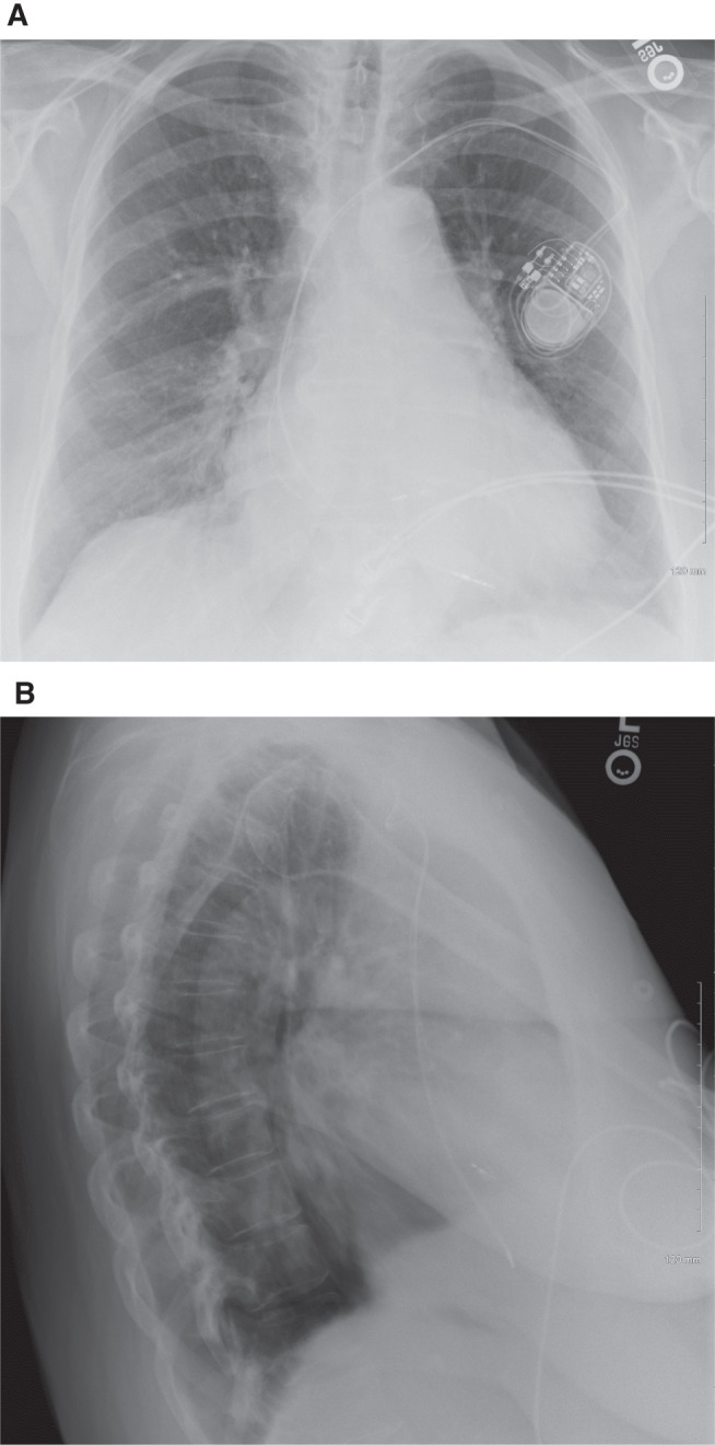 A Novel Technique for Conduction System Pacing in Patients Undergoing Simultaneous Ablation of the Atrioventricular Node Using Axillary Venous Access.