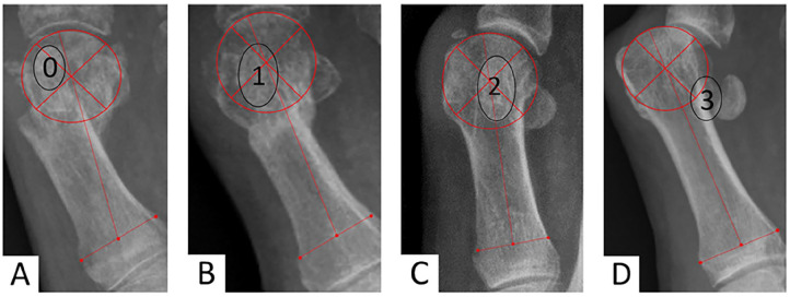 Correction of Severe Hallux Valgus Deformity Using a Percutaneous Metatarsal Distal Osteotomy.