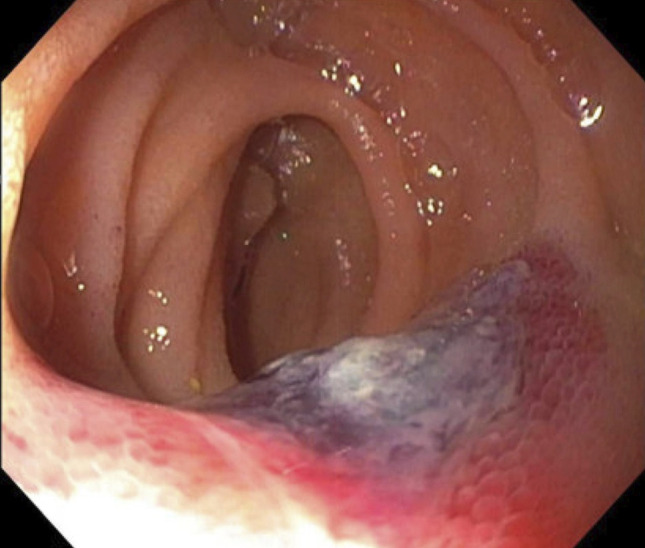 Primary Jejunal Angiosarcoma.