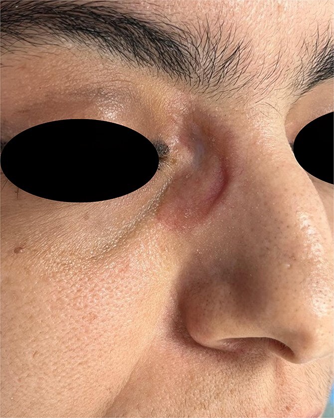 An unusual presentation of cutaneous sarcoidosis induced by Koebner's phenomenon.