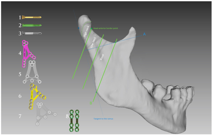 Risk of Permanent Dysfunction of Facial Nerves After Open Rigid Internal Fixation in the Treatment of Mandibular Condylar Process Fracture.